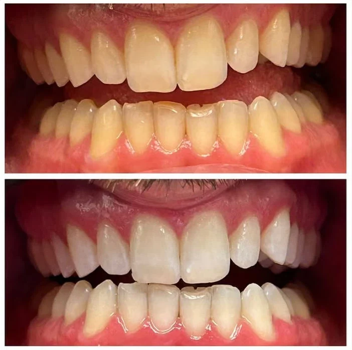 Dental Work Case 3 - Same-Day CEREC Crown Restoration